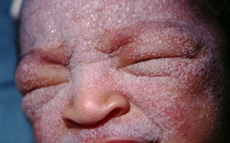 infant heat rash pictures. Miliaria crystallina in an