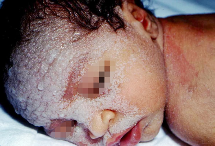 heat rash on face treatment. newborn heat rash on face. in