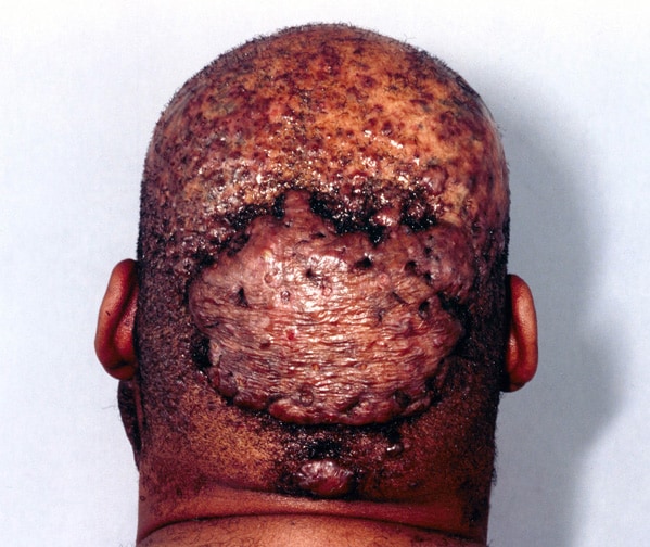 This man also had perifolliculitis of the scalp and acne conglobata (the 