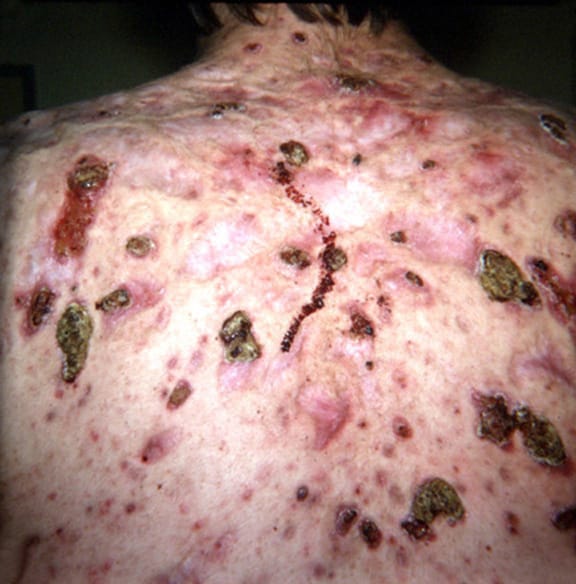 A closer view of nodules and pustules on the back.