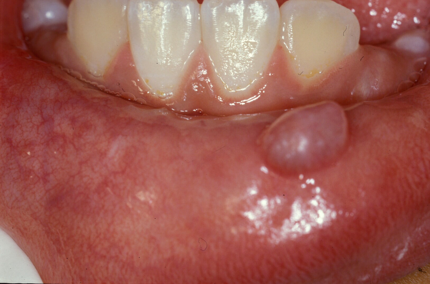 Clear Bumps In Mouth 55