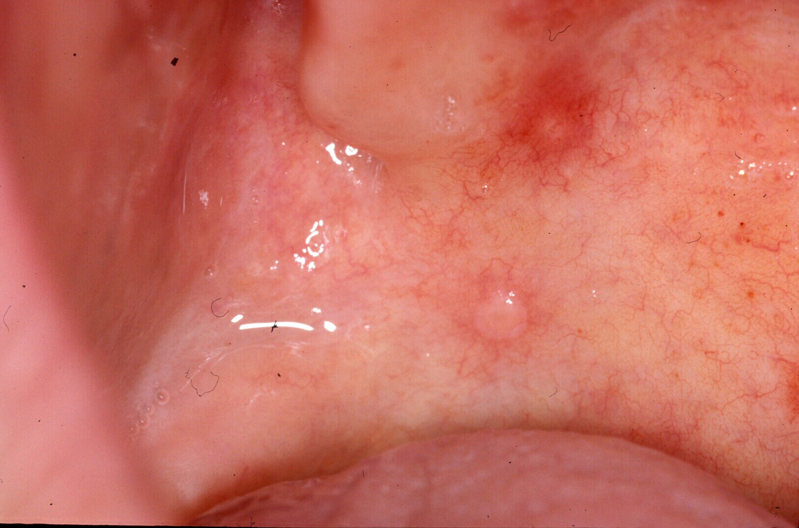 Soft Palate Mucocele