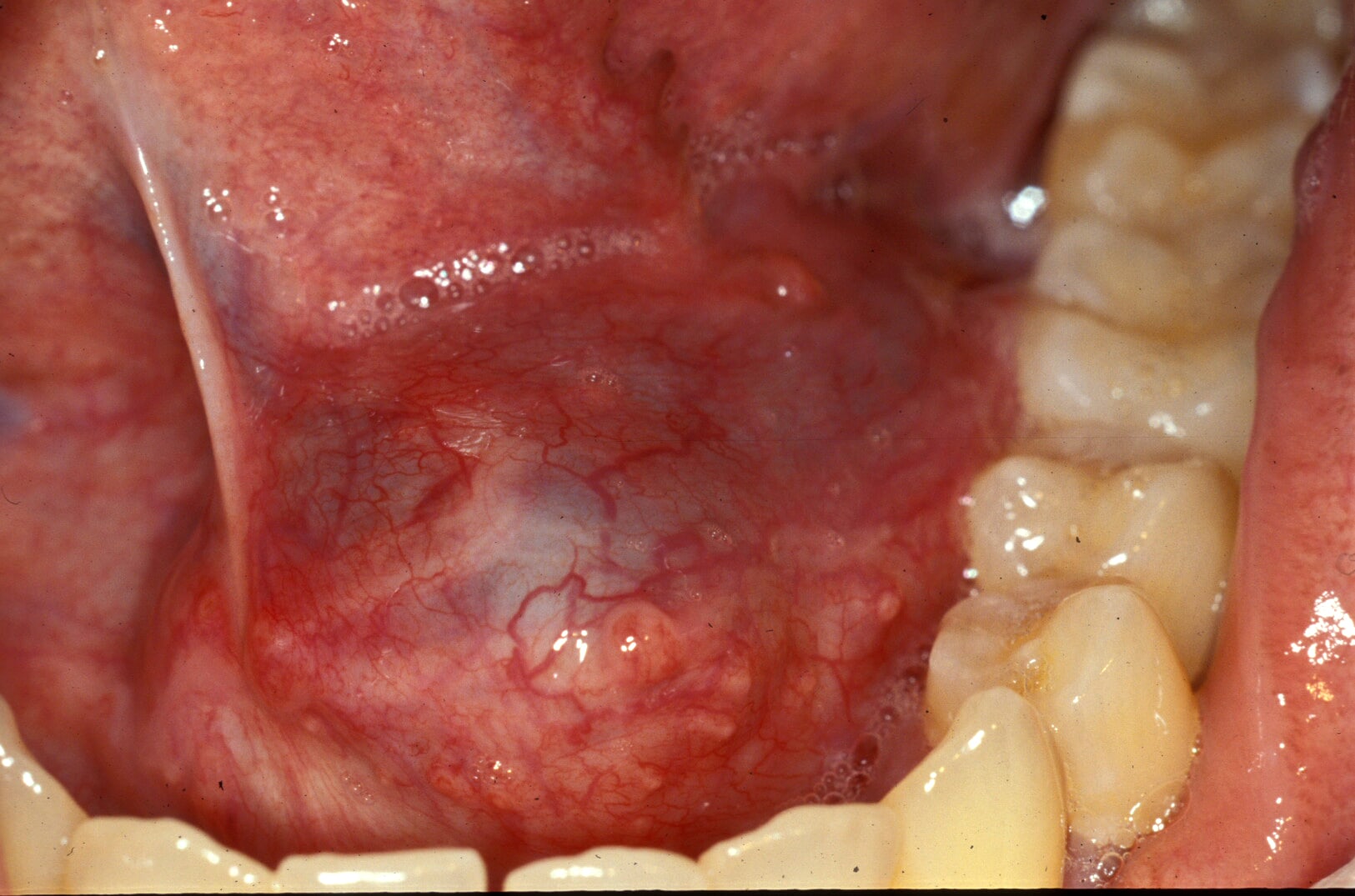 Unilateral oral ranula in a  young adult manifesti...