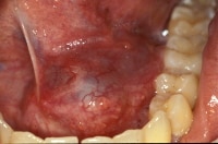 Unilateral oral ranula in a young adult manifesti...