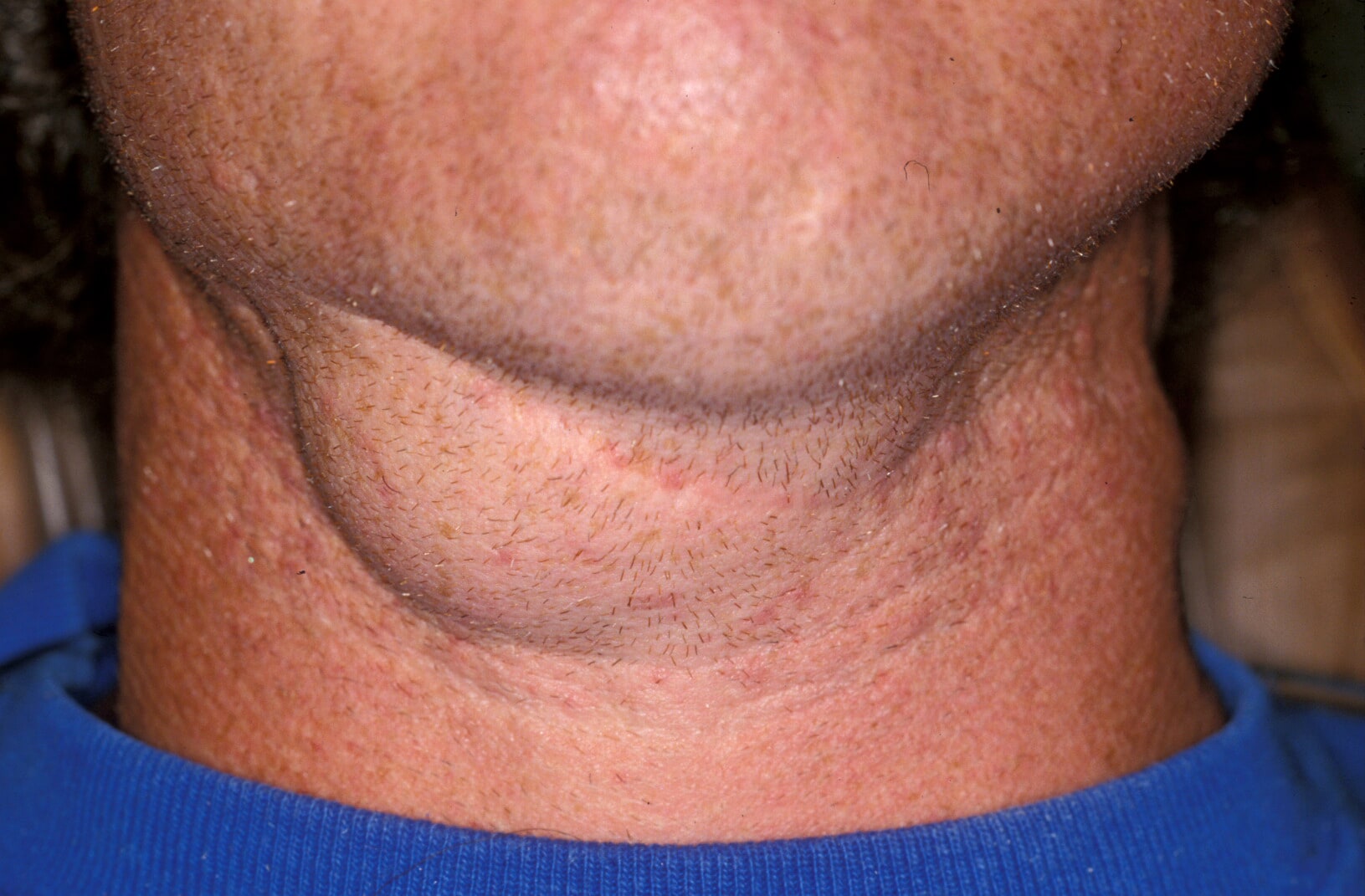 swollen mass under chin