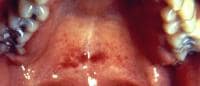 A 21-year-old woman with  infectious mononucleosis...