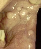 Lesions on the buccal mucosa  caused by human papi...