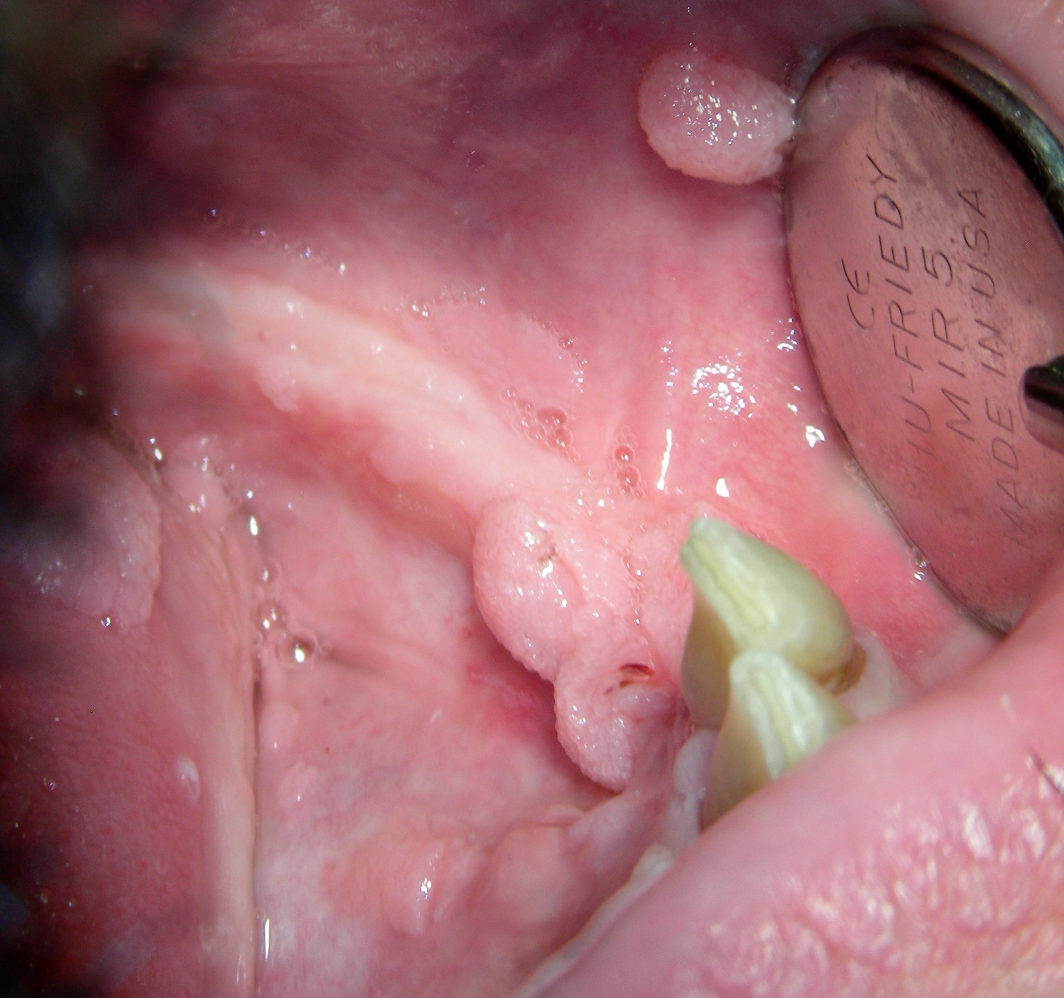 Multiple condylomas are seen in this HIV+ male wi. 