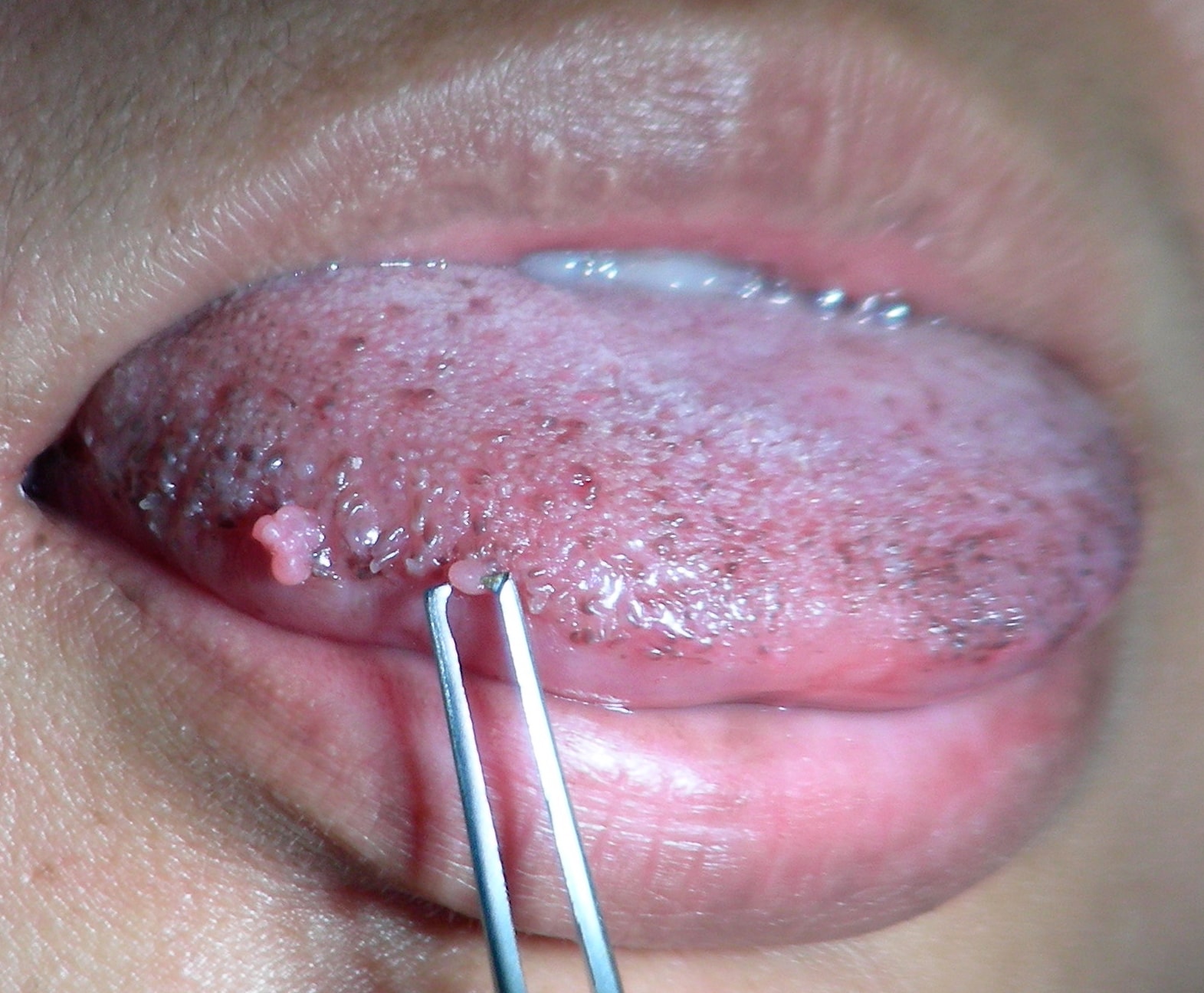 These small papillomas on the  lateral tongue of a...