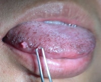 These small papillomas on the lateral tongue of a...