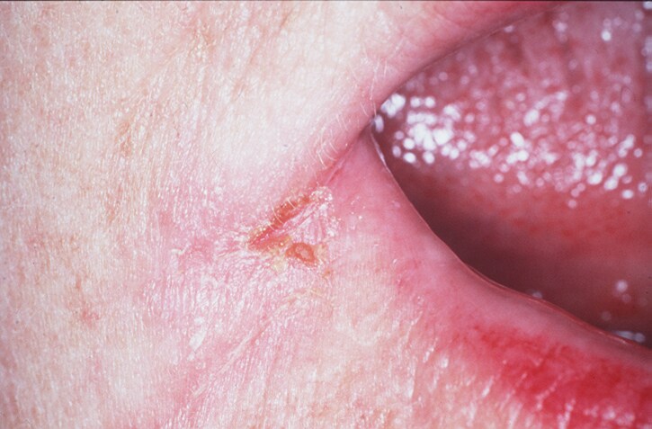 Angular stomatitis; a common  form of oral candidi...