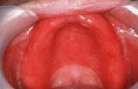 Denture-related stomatitis; a common form of oral...
