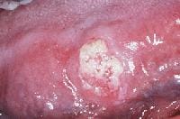 Carcinoma referred to as a leukoplakia.