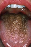 Brown hairy tongue in a middle-aged woman who dri...