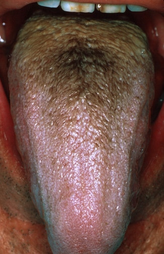 Brown hairy tongue in a  middle-aged man who smoke...