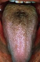 Brown hairy tongue in a middle-aged man who smoke...