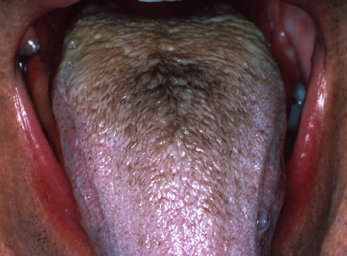 Black hairy tongue - Mayo Clinic