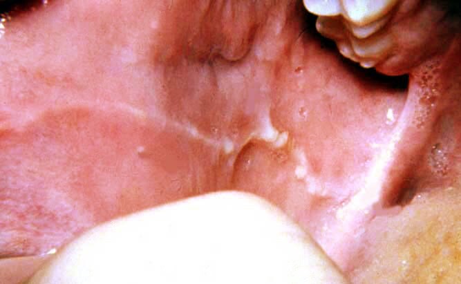 Scalloped Tongue Causes