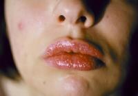 contact dermatitis lips