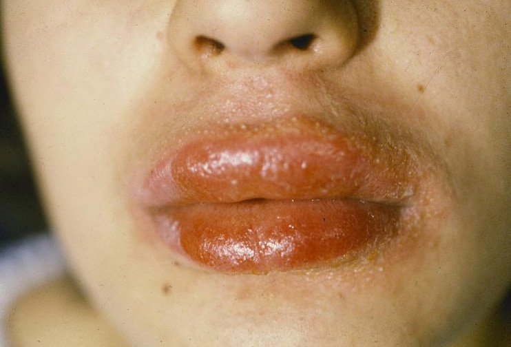 Allergic contact dermatitis involving the lips an.
