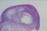 Mucus Extravasation Phenomenon