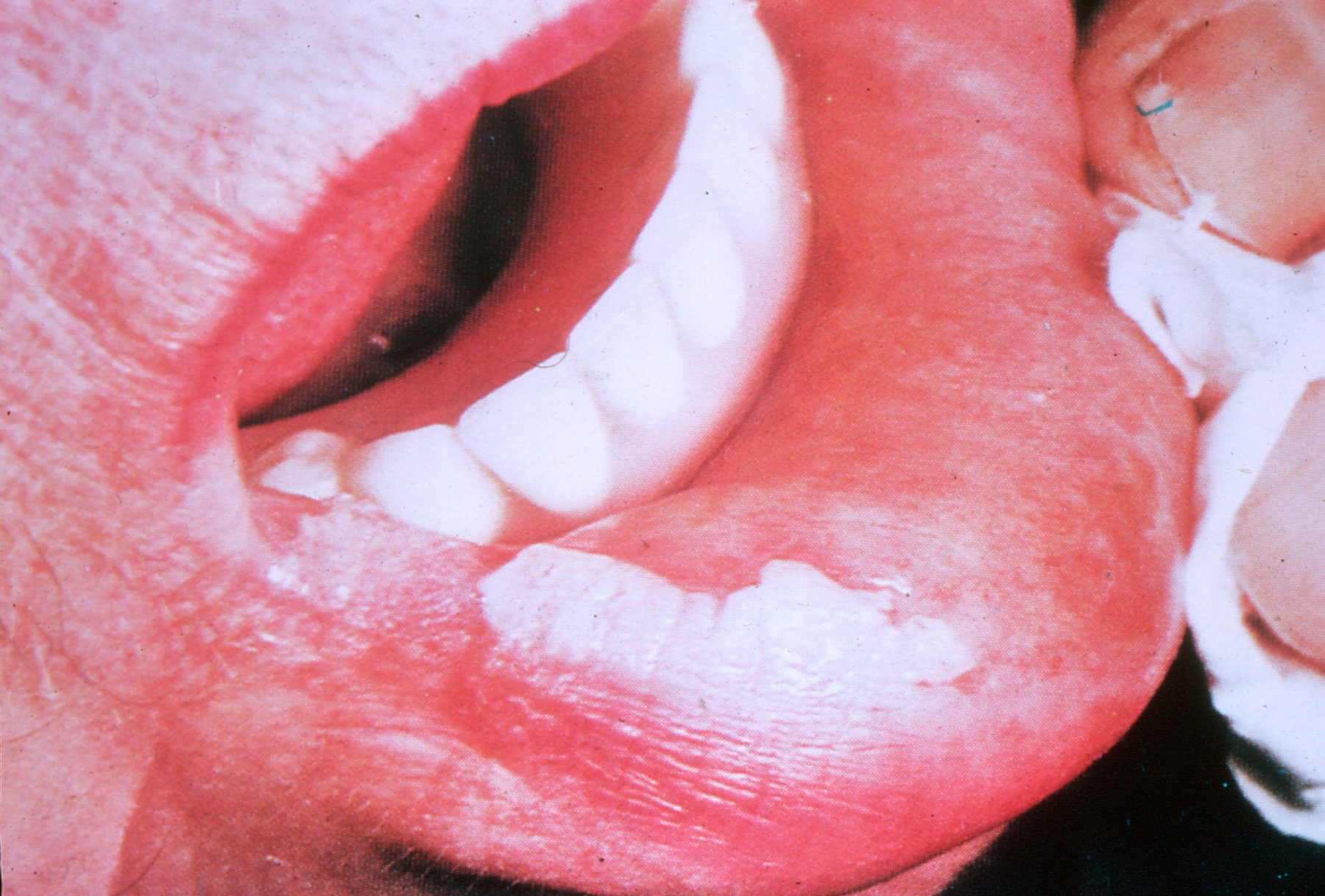 Oral leukoplakia.