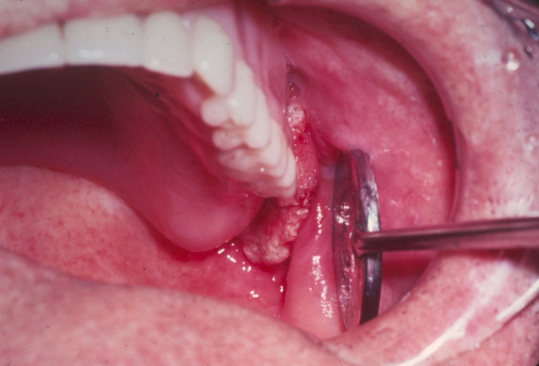 Denture Hyperplasia, Epulis Fissuratum