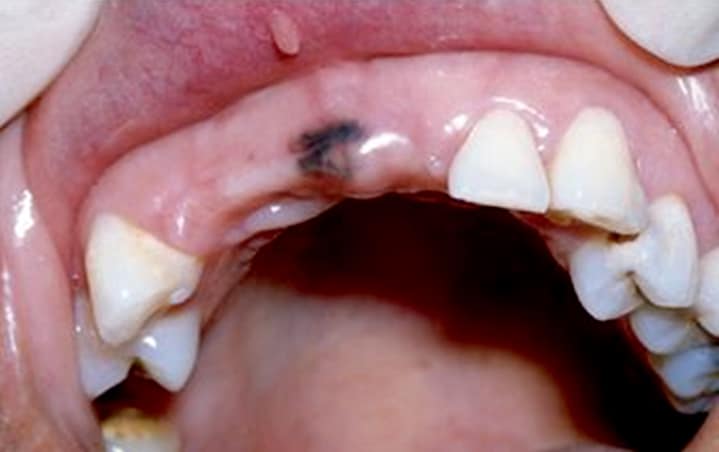 Oral Melanotic Macules 98