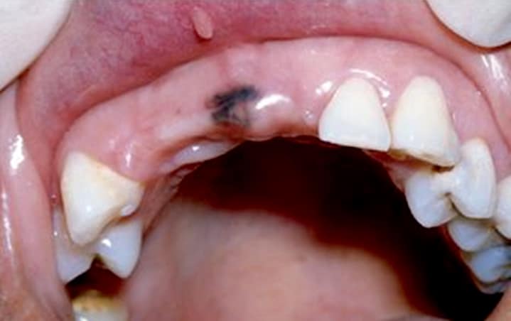 Oral Pigmentation