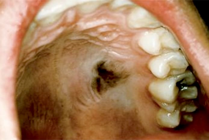 Oral And Maxillo Facial Surgery Disorders Of Oral Pigmentation