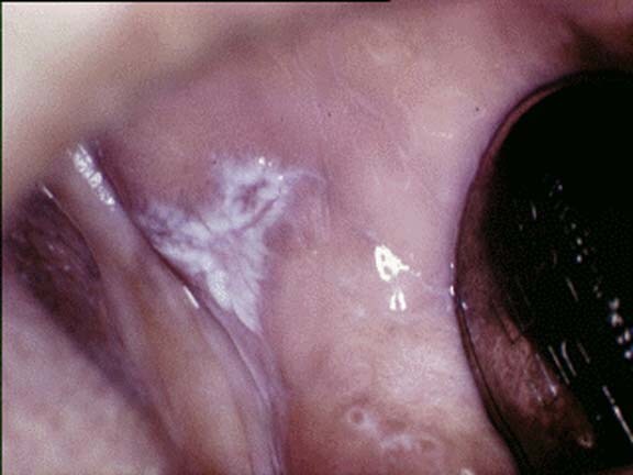 Plaquelike oral lichen planus on  the buccal mucos...