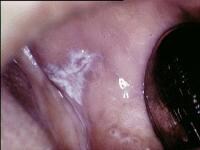 Plaquelike oral lichen planus on the buccal mucos...