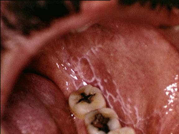 Reticular oral lichen planus on  the buccal mucosa...