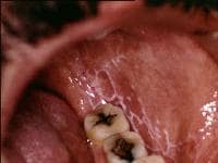 Reticular oral lichen planus on the buccal mucosa...