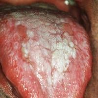 Ulcerative oral lichen planus on the dorsum of th...