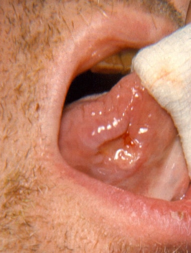 ulcers on tongue. Ulcer on the ventrolateral