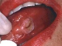 Indurated Ulcer