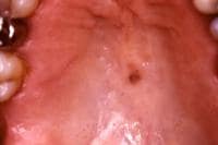 Brown Spots In Mouth 22