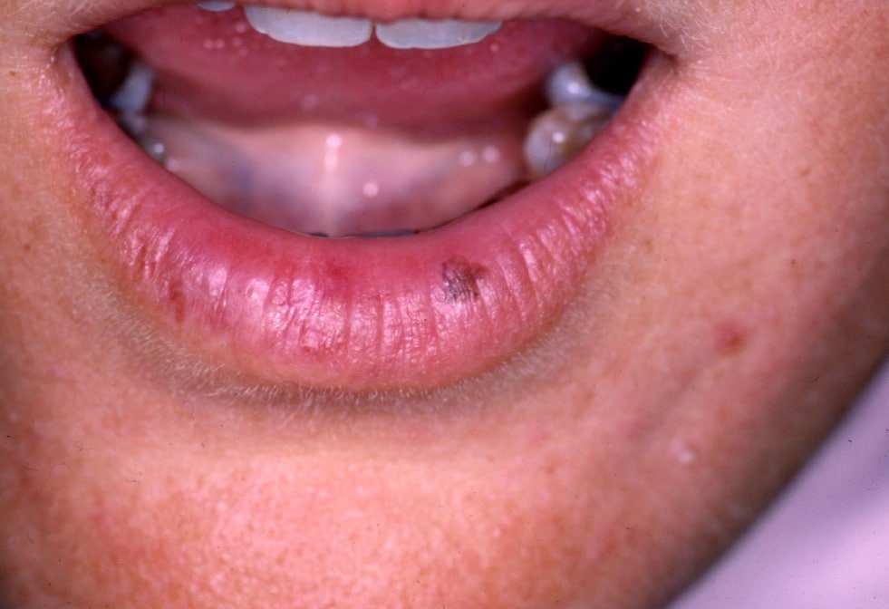 dark patch above upper lip