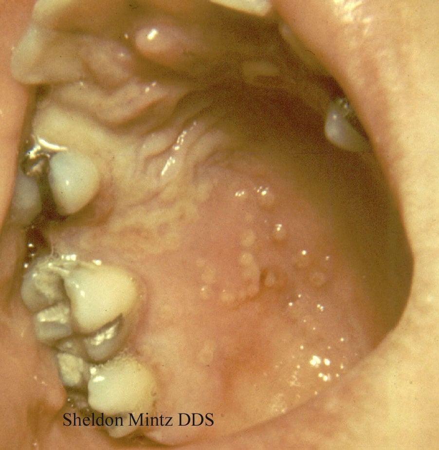 Human herpesvirus (HHV) type 1.  Recurrent herpes ...