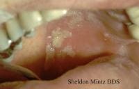 Human herpesvirus (HHV) type 3. Intraoral herpes ...