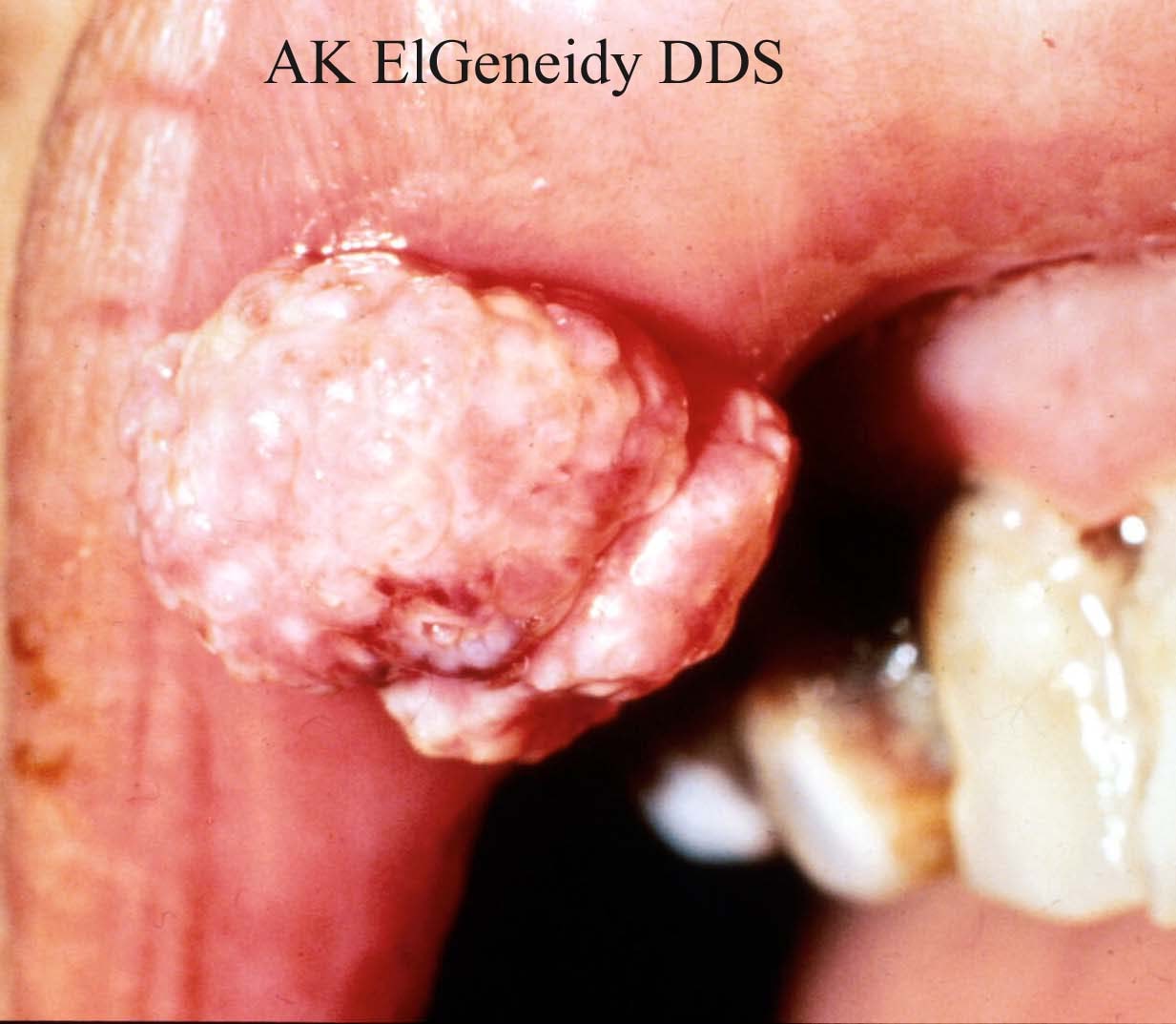 Pictures of Papilloma of the Tonsil - Otolaryngology Houston