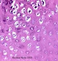 Human papillomavirus (HPV). Koilocytes in the upp...