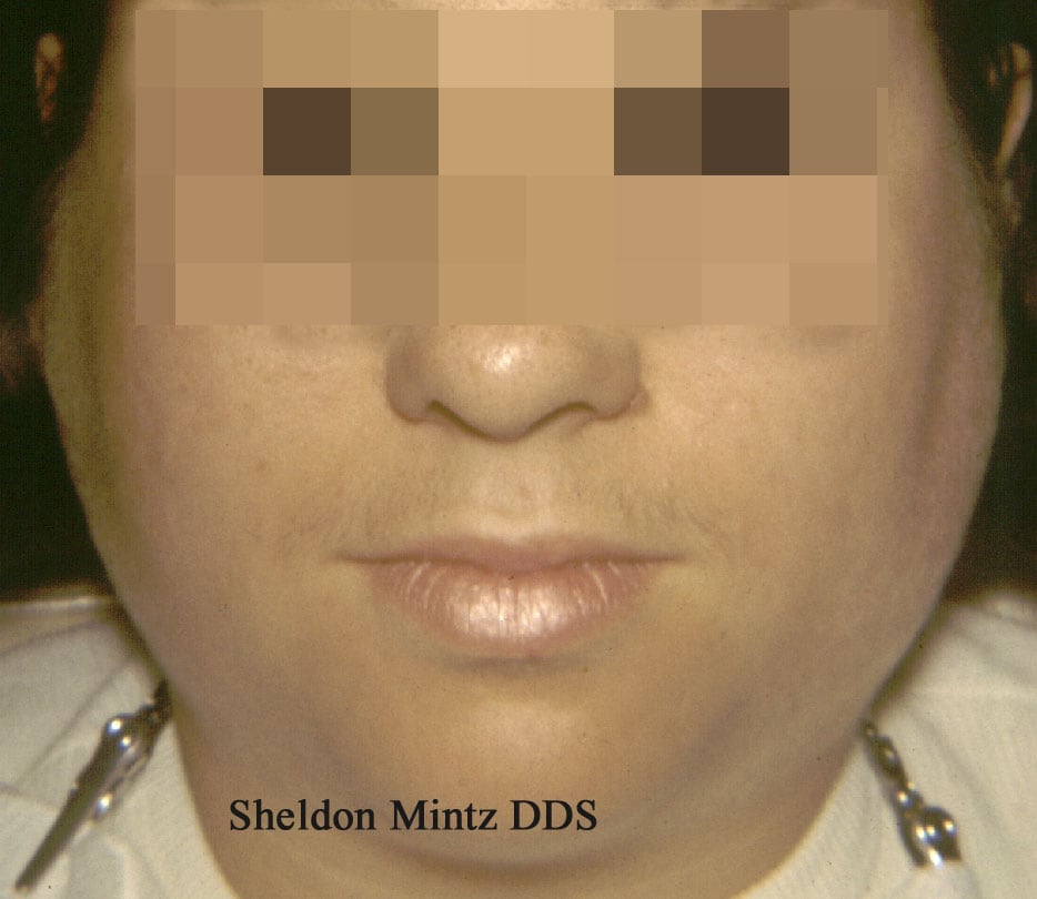 This patient with mumps has  marked bilateral swel...