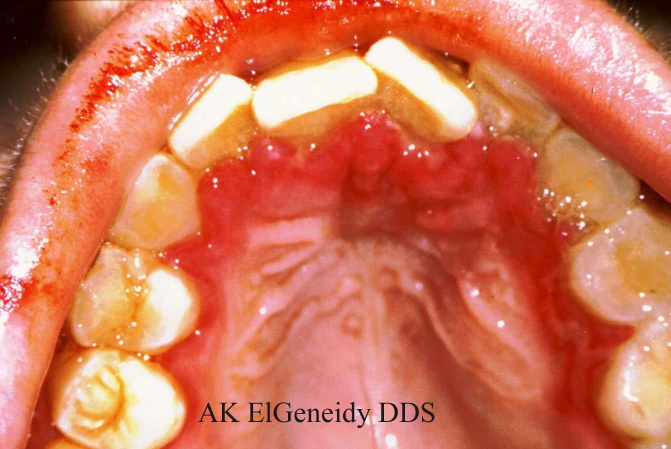 ORAL & MAXILLO-FACIAL SURGERY: Viral Infections of the Mouth