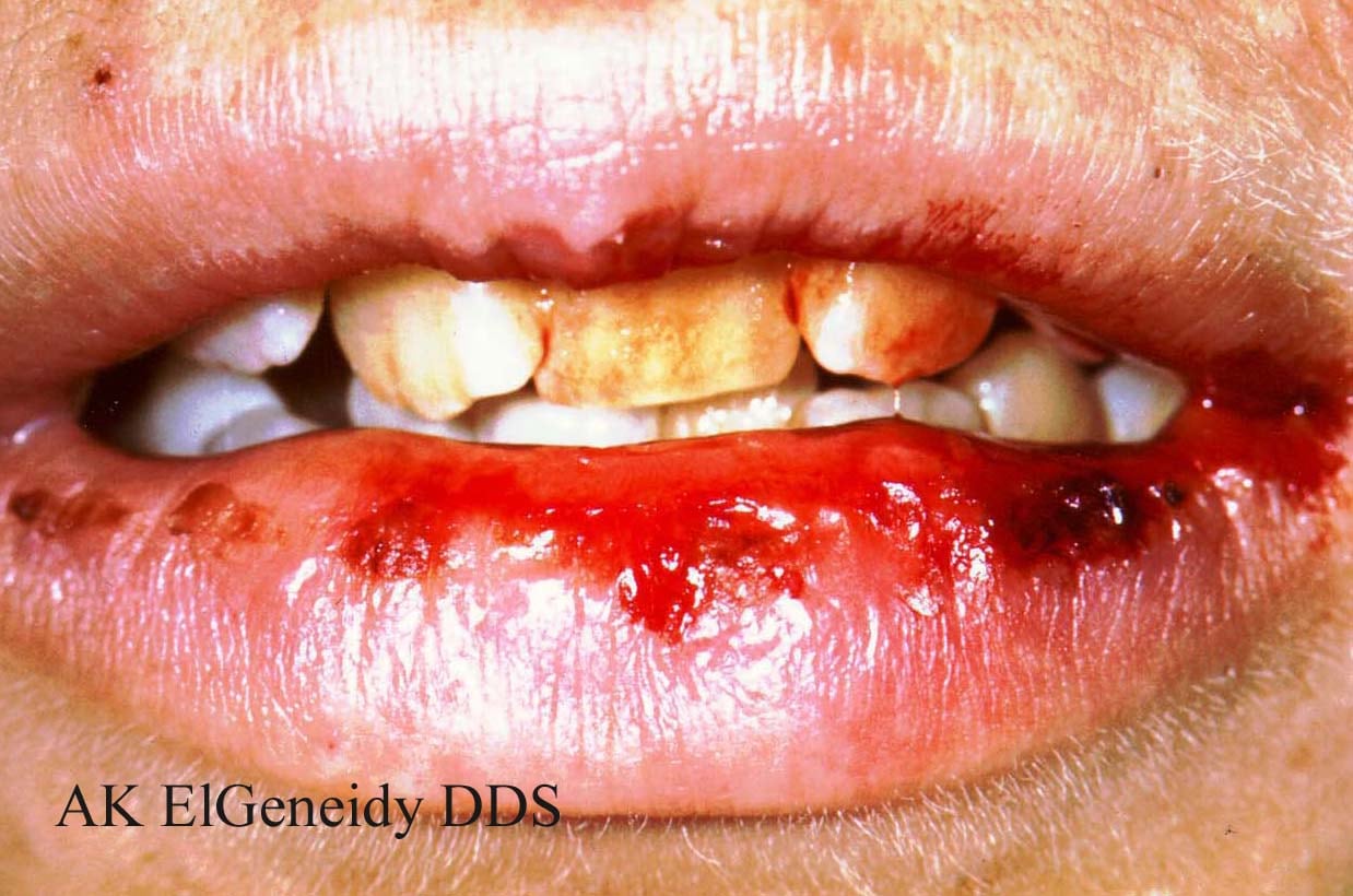 Primary Oral Herpes