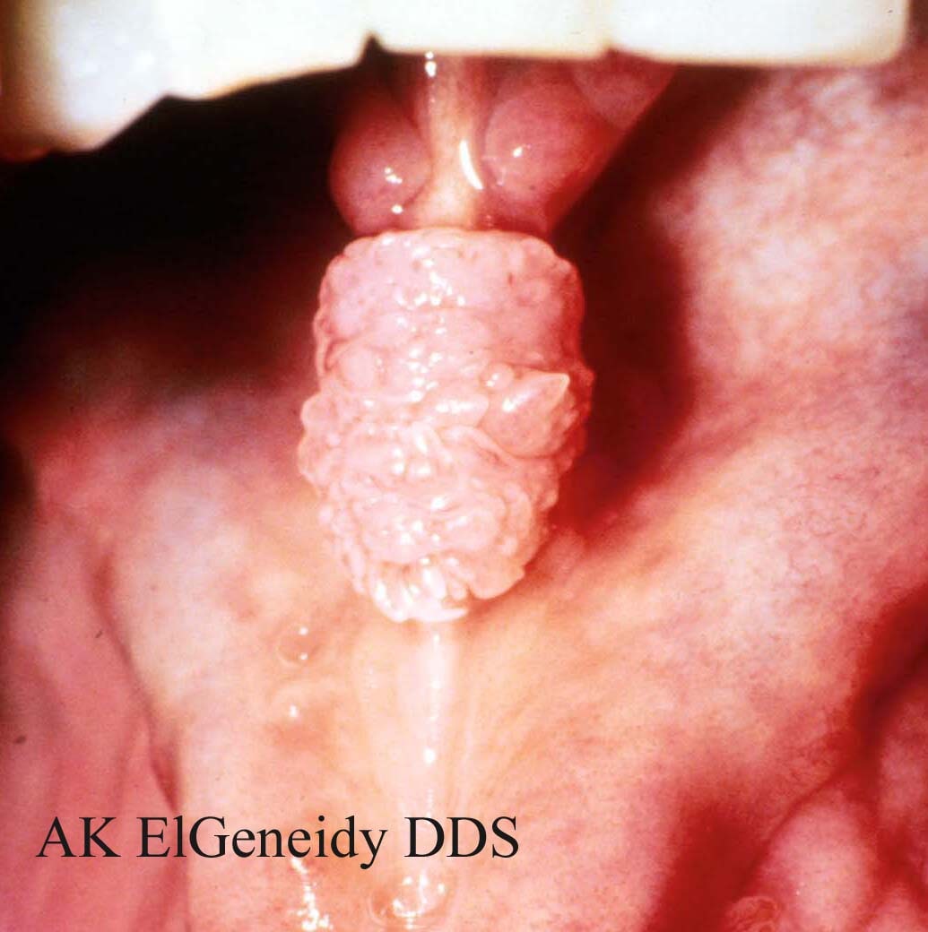 hpv tonsil