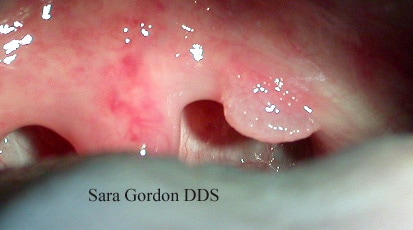 Herpes Zoster Picture Image on MedicineNet.com