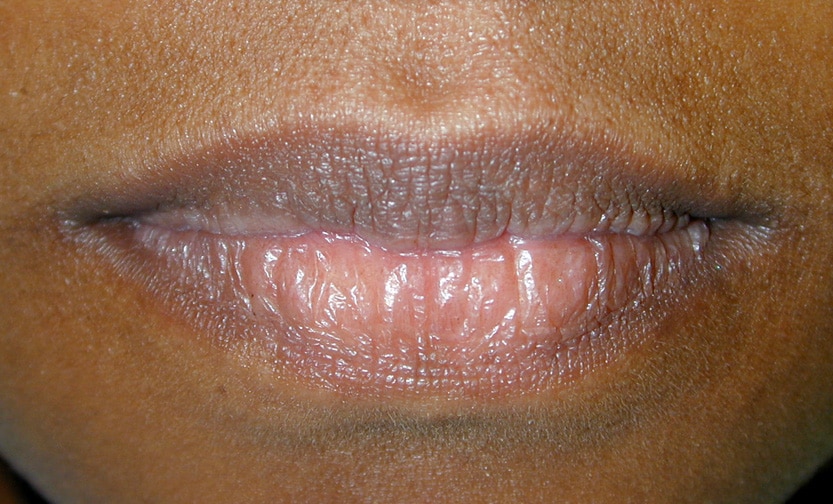 mild herpes on lip