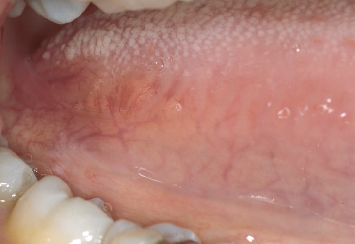 circumvallate papillae definition